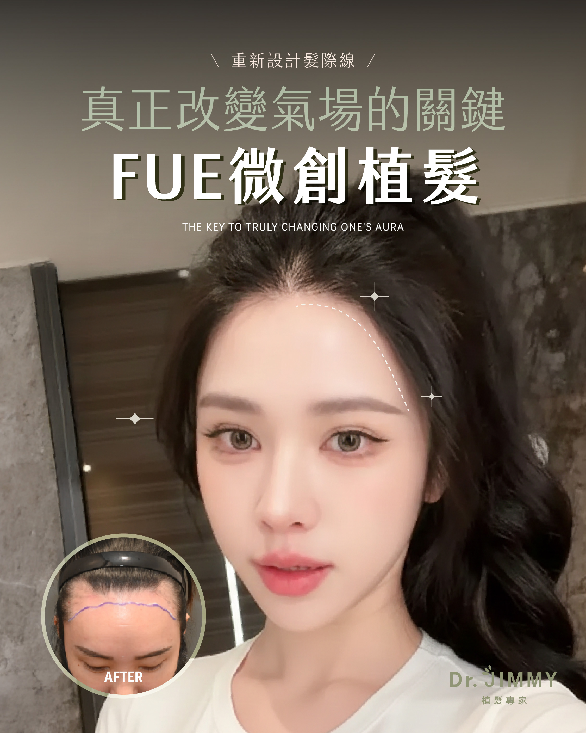 FUE植髮 vs 吃藥五年後差在哪?