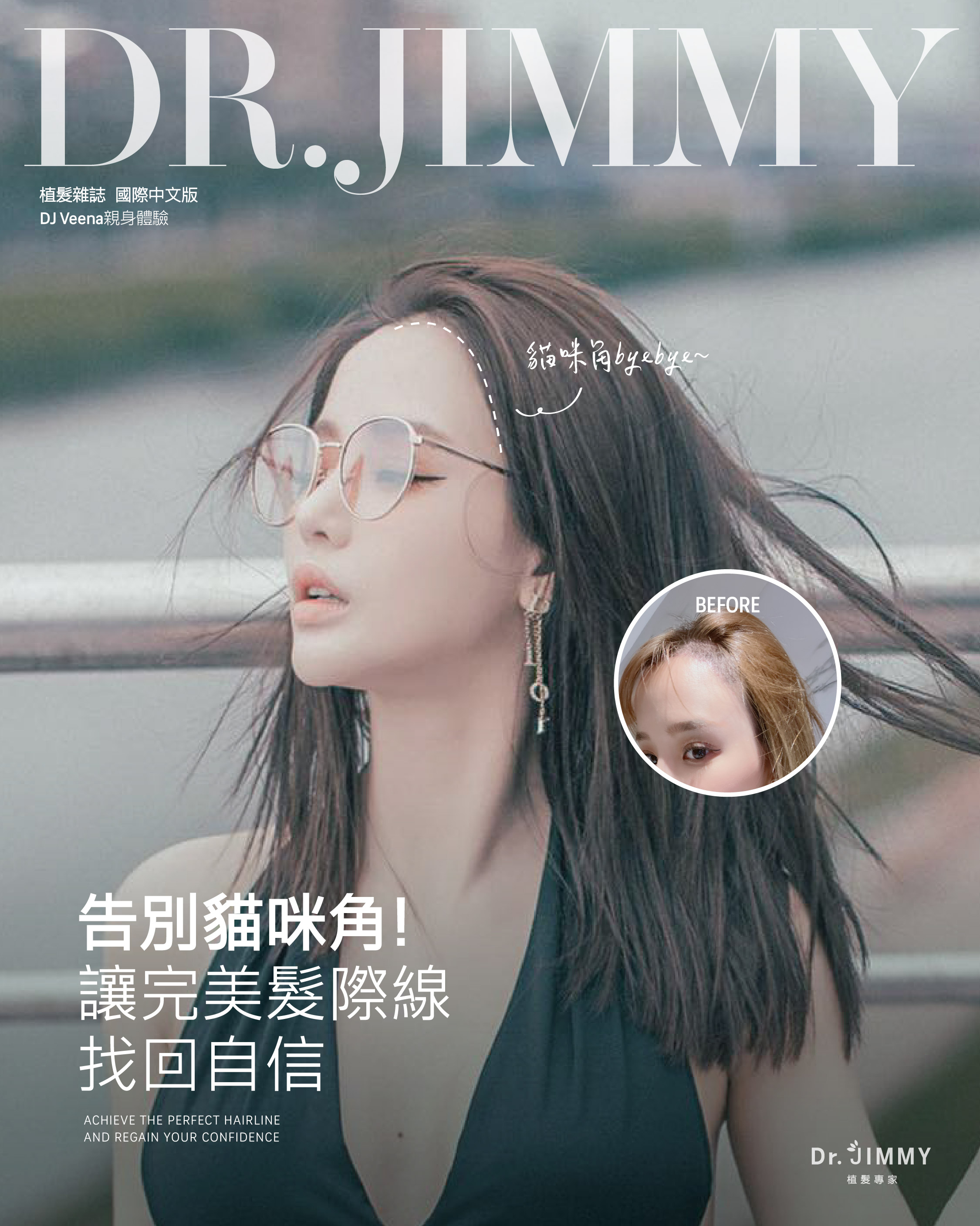 FUE植髮 vs 吃藥五年後差在哪?