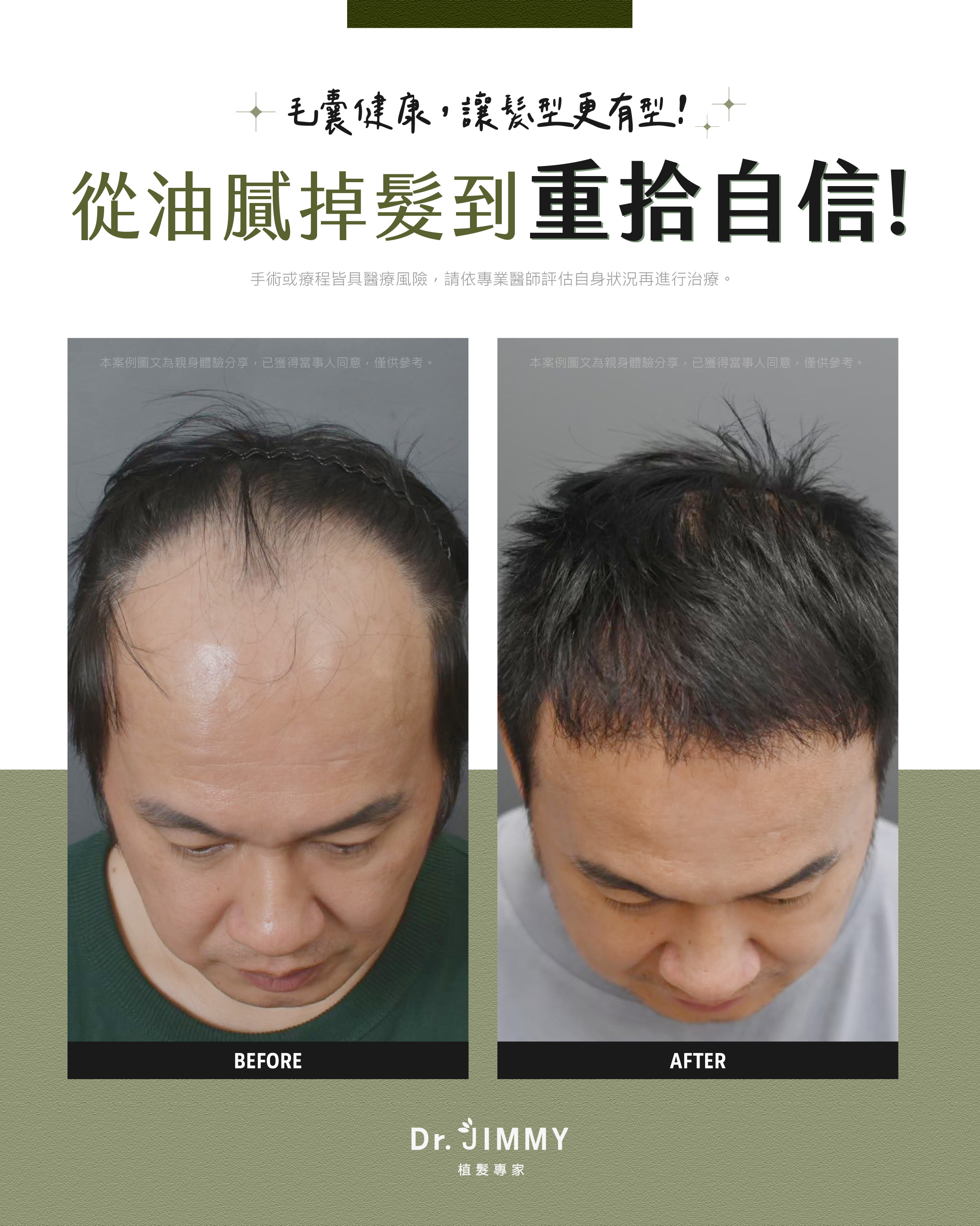 植髮缺點有哪些？植髮副作用解析＆適合對象總整理，安心決定不後悔！