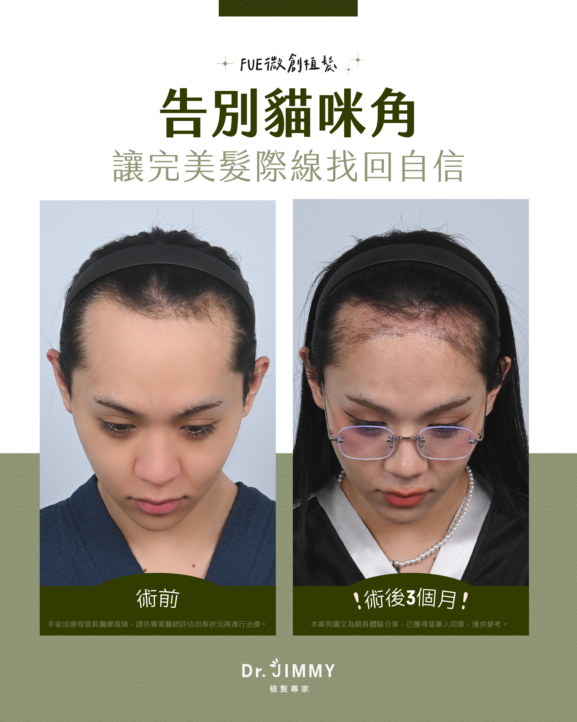 女生植髮最容易後悔的 3 種錯誤期待