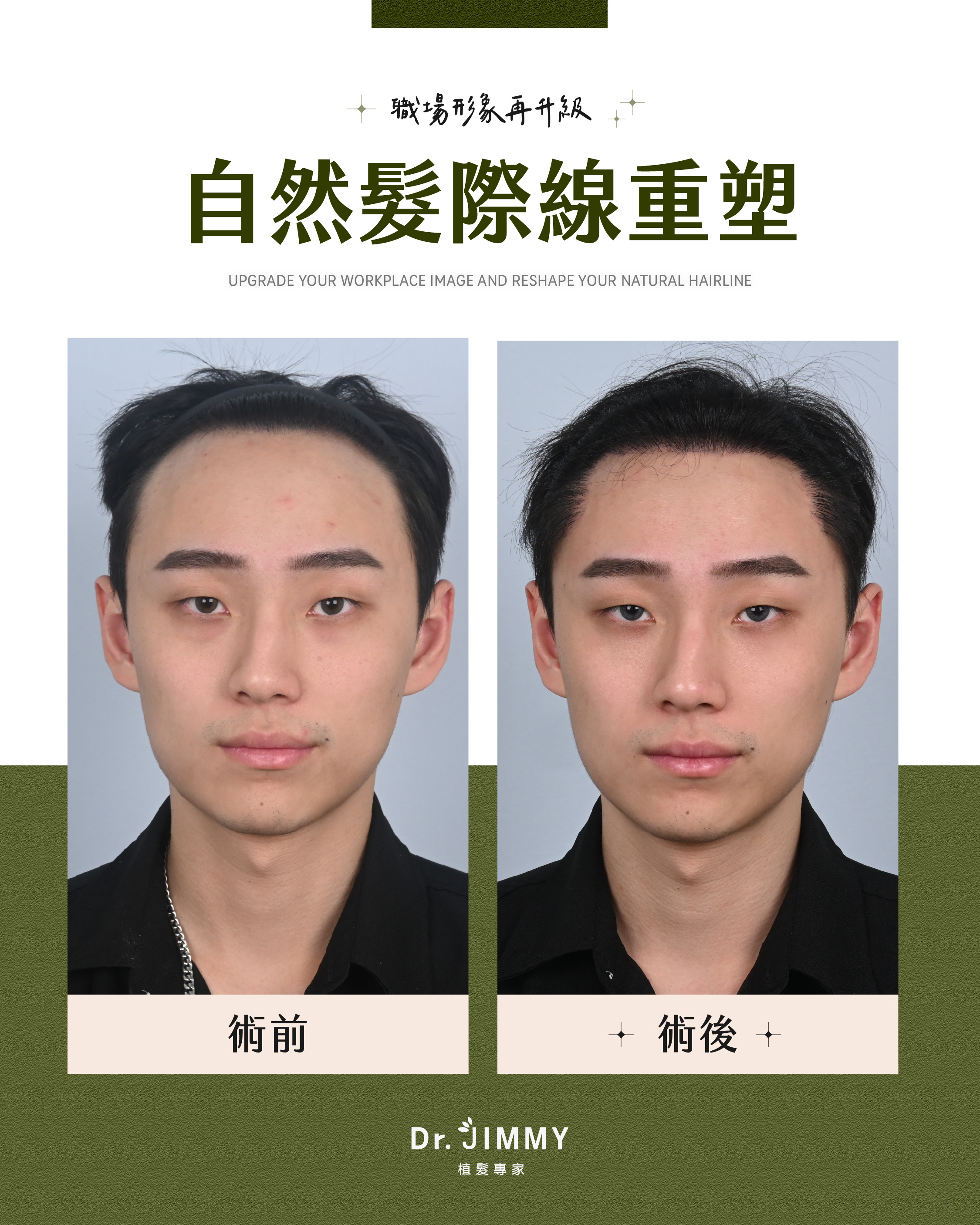 植髮恢復期全攻略：第1週到第12個月的變化與照護重點
