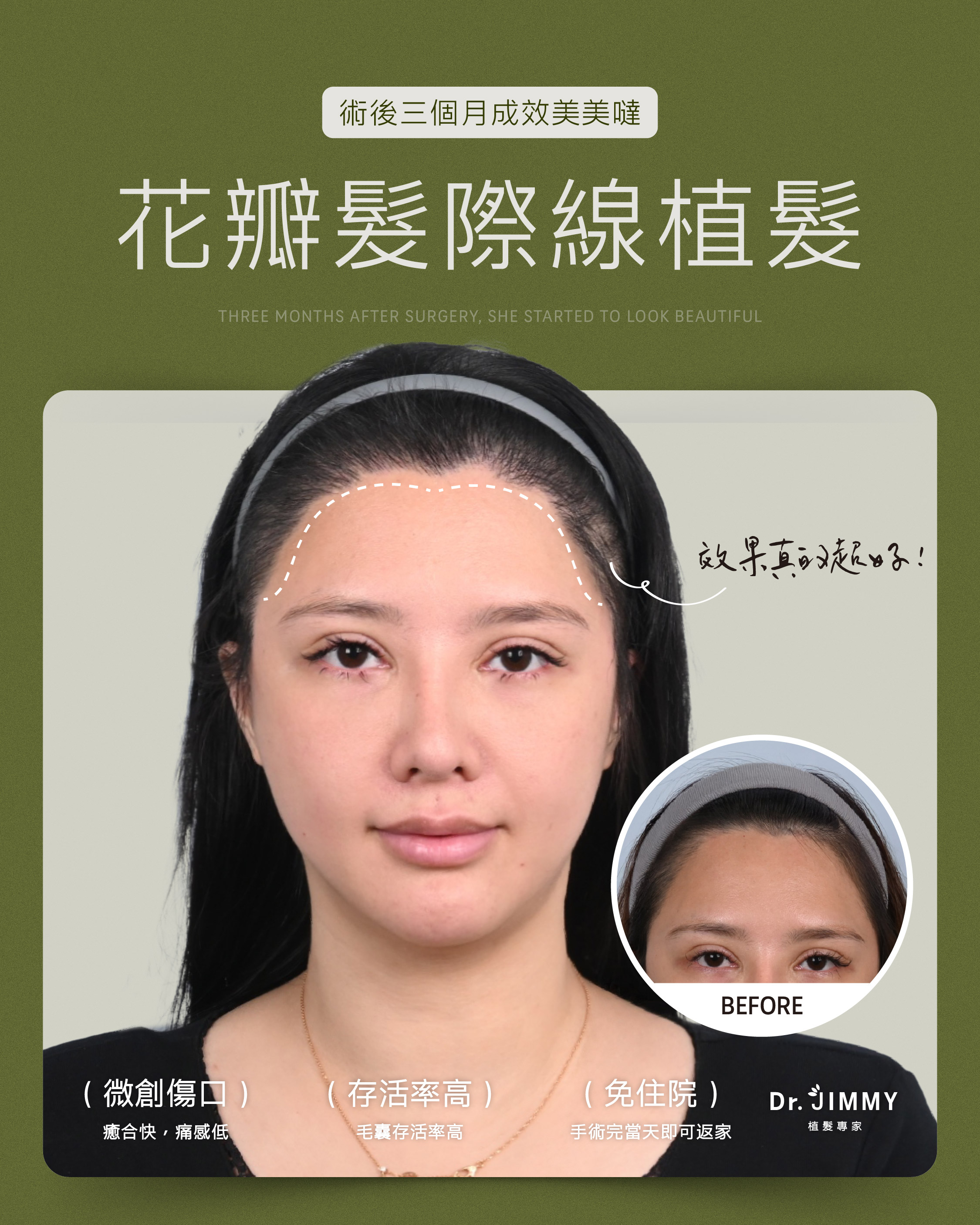 手術或療程皆具醫療風險，請依專業醫師評估自身狀況再進行治療。本案例圖文為親身體驗分享，已獲得當事人同意，僅供參考。
