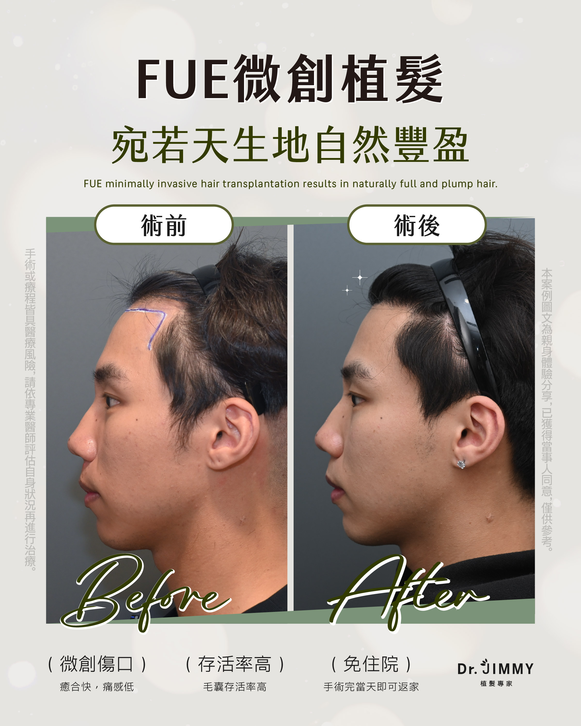 植髮失敗還能補救嗎?哪些情況有救、哪些沒有?