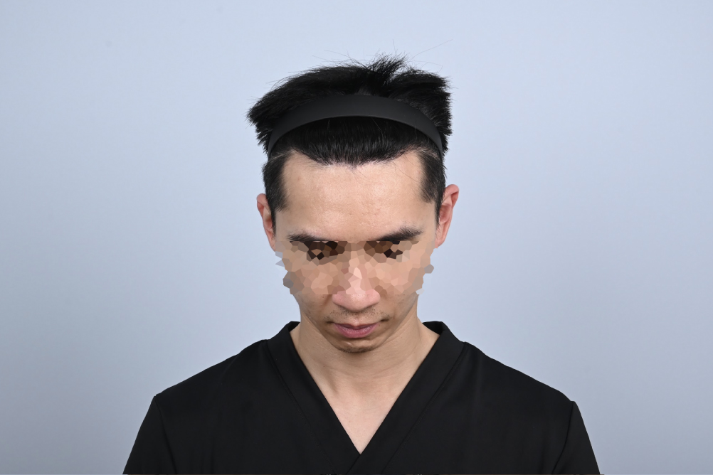 Dr. Jimmy案例分享,FUE植髮手術術後12個月