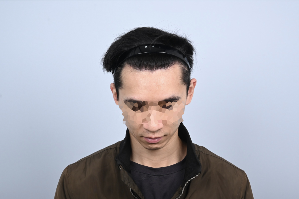 台南植髮推薦怎麼選?醫師教你避開5個常見陷阱,植髮前一定要知道!