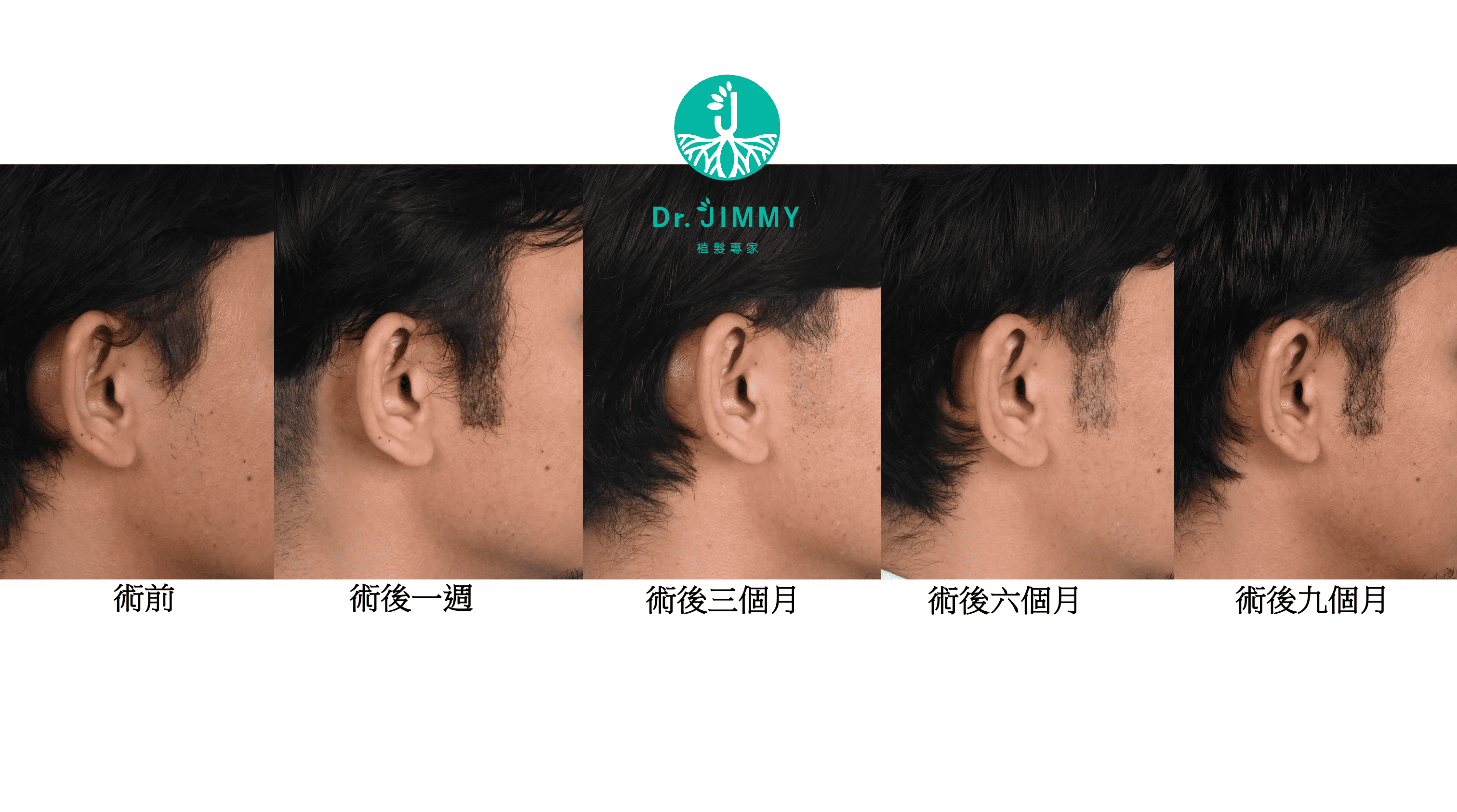 鬍鬚與鬢角植髮指南:造型設計、手術流程、恢復期與費用