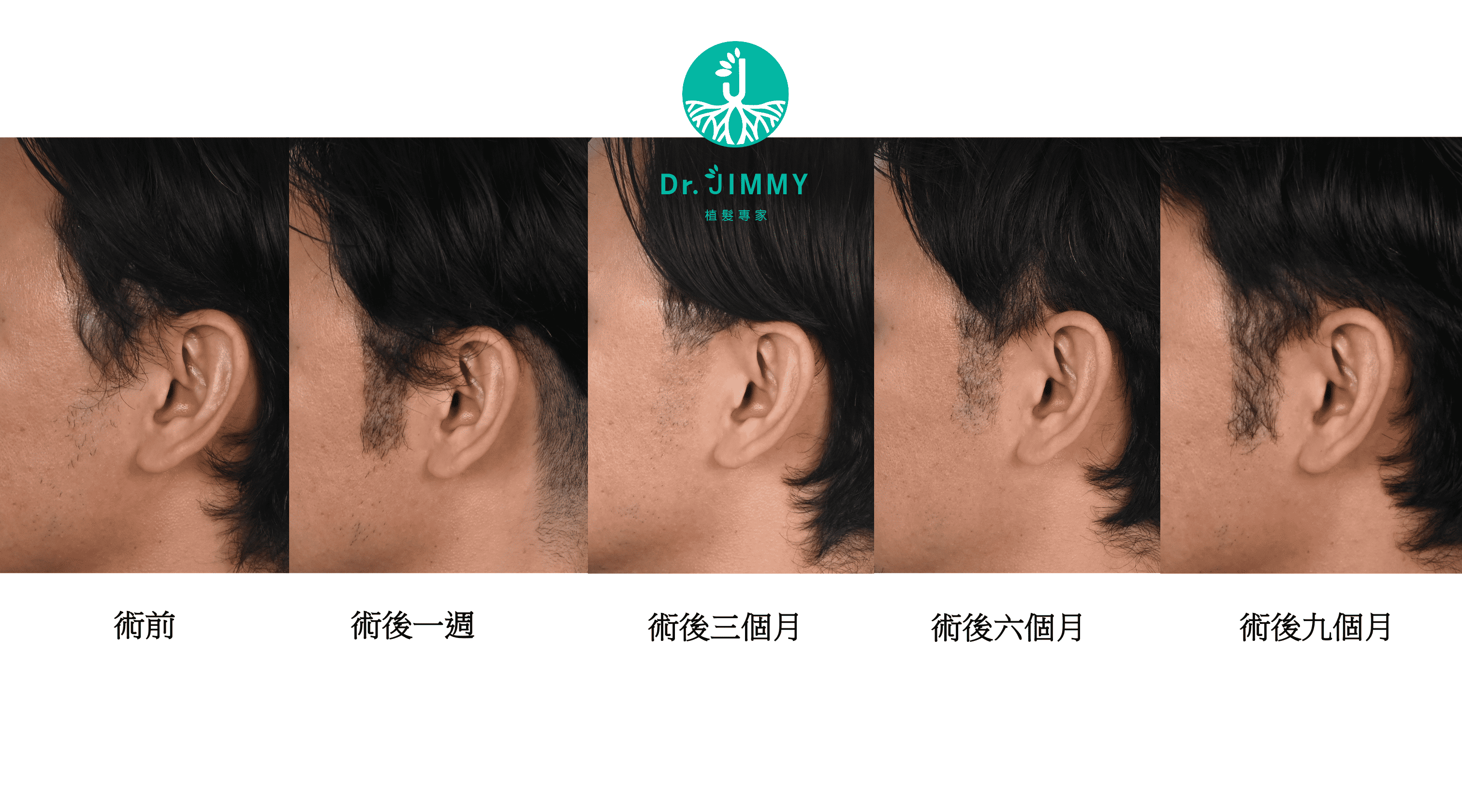 鬍鬚與鬢角植髮指南:造型設計、手術流程、恢復期與費用