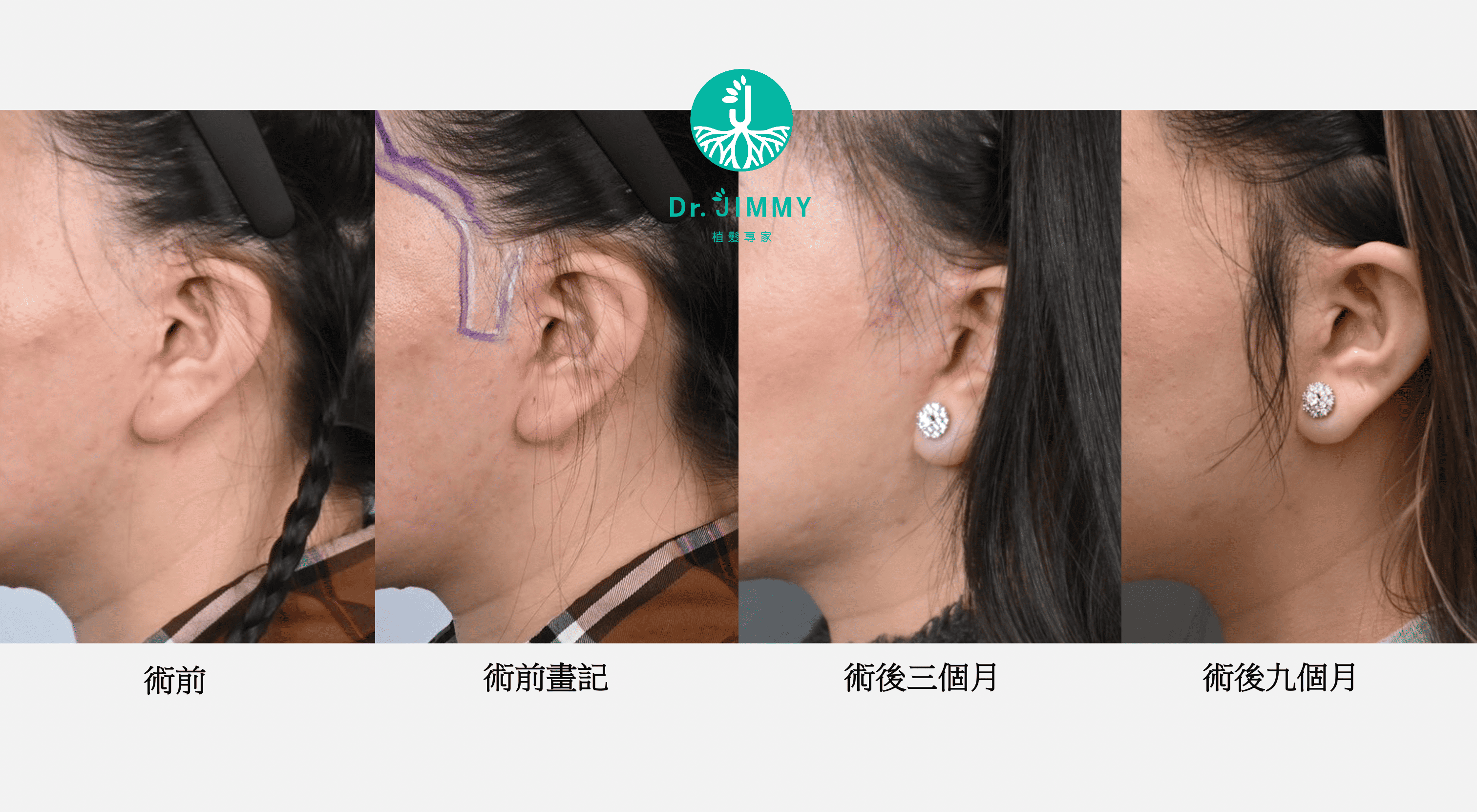 鬍鬚與鬢角植髮指南:造型設計、手術流程、恢復期與費用