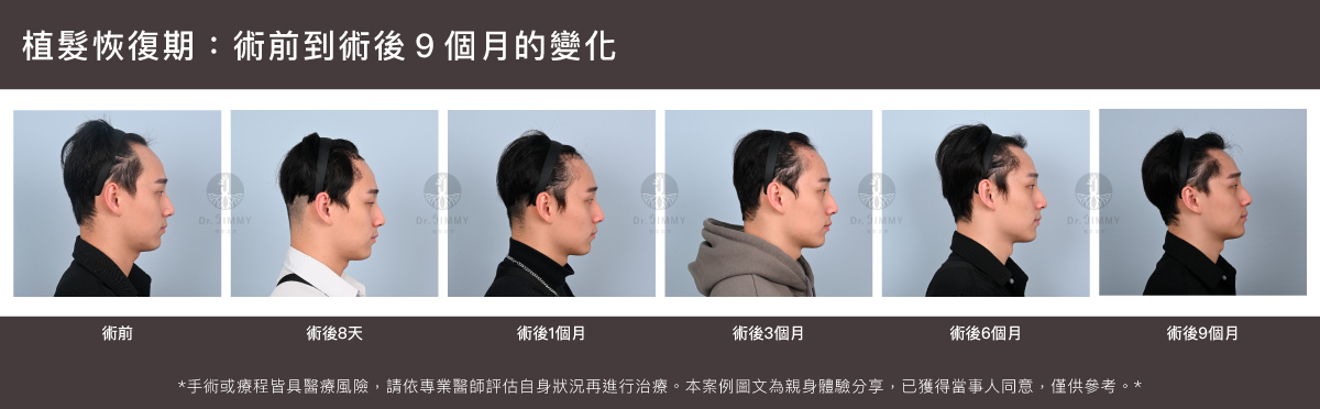 植髮恢復期全攻略：第1週到第12個月的變化與照護重點