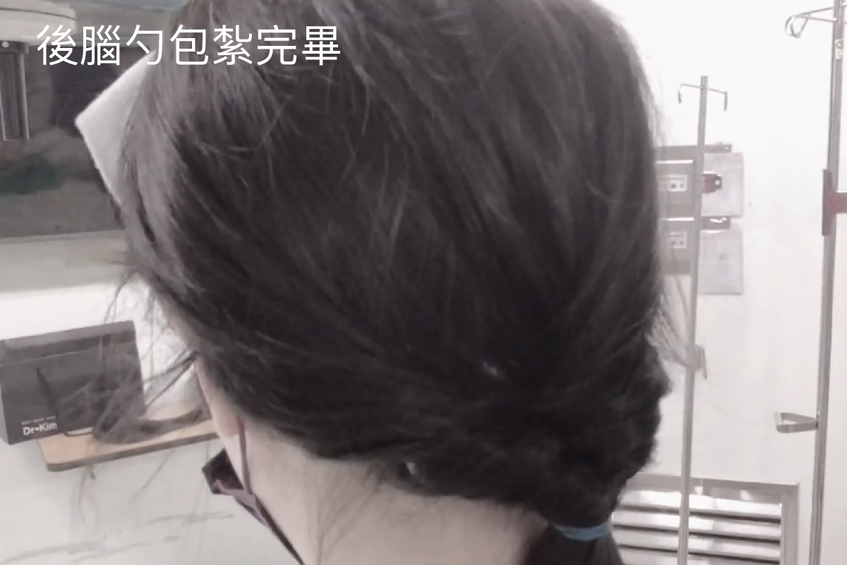 植髮會被同事發現嗎？上班族必看：真實恢復時間線與「不顯眼植髮」全攻略