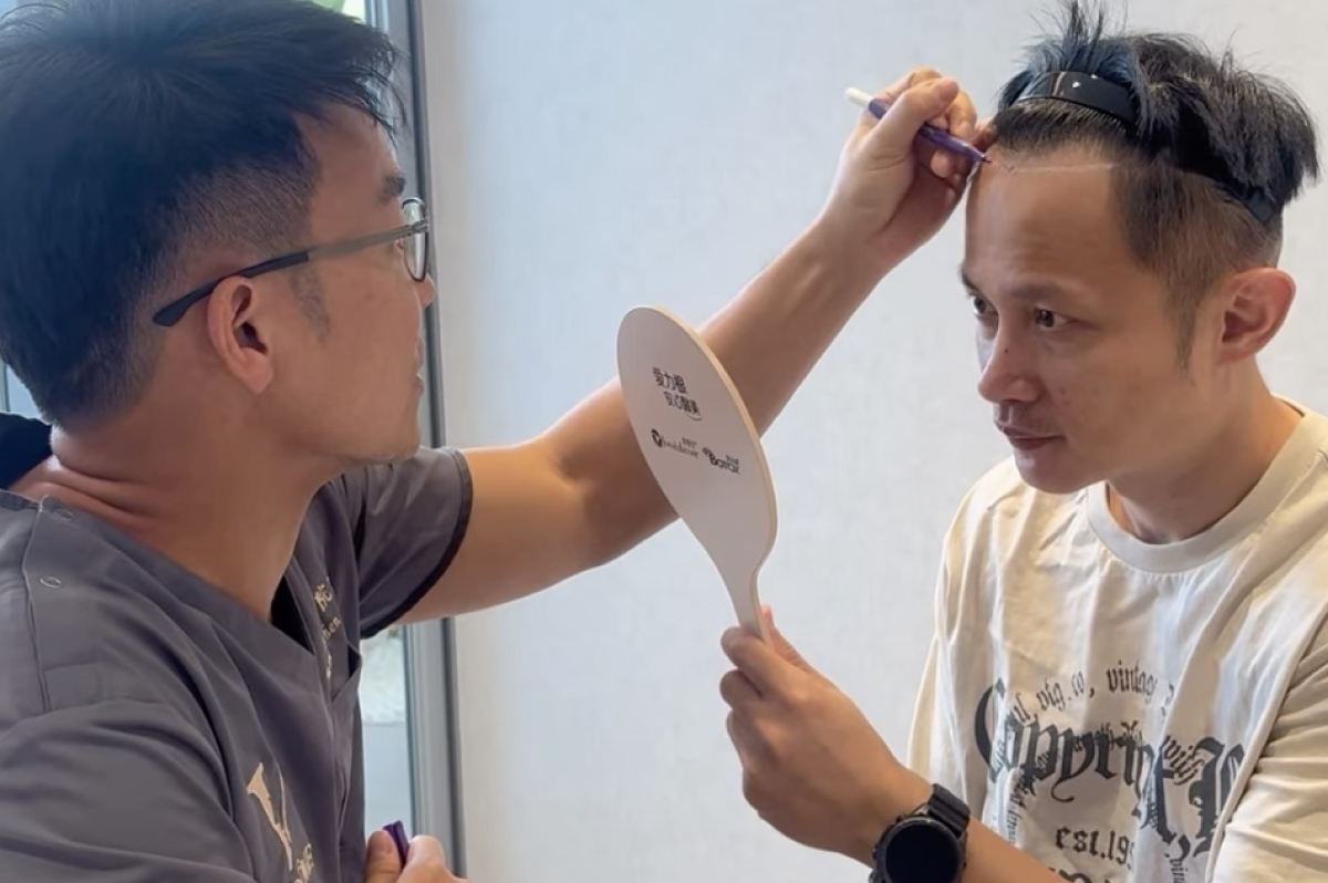 植髮自然不破功：密度、髮流與角度設計的專業原則（植髮密度全解析）
