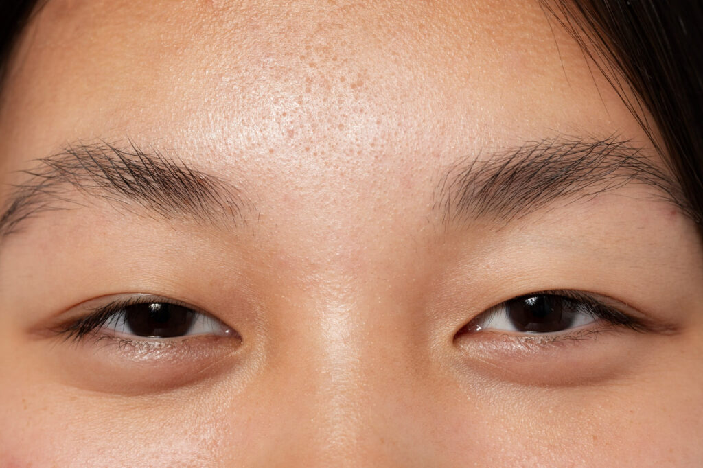 提眼瞼肌手術｜你有提眼瞼肌下垂嗎？打開你的眼睛，眼神亮起來！