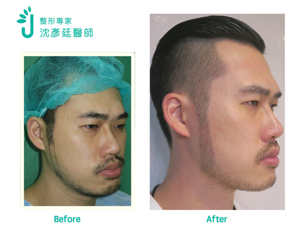 鬍鬚與鬢角植髮指南:造型設計、手術流程、恢復期與費用