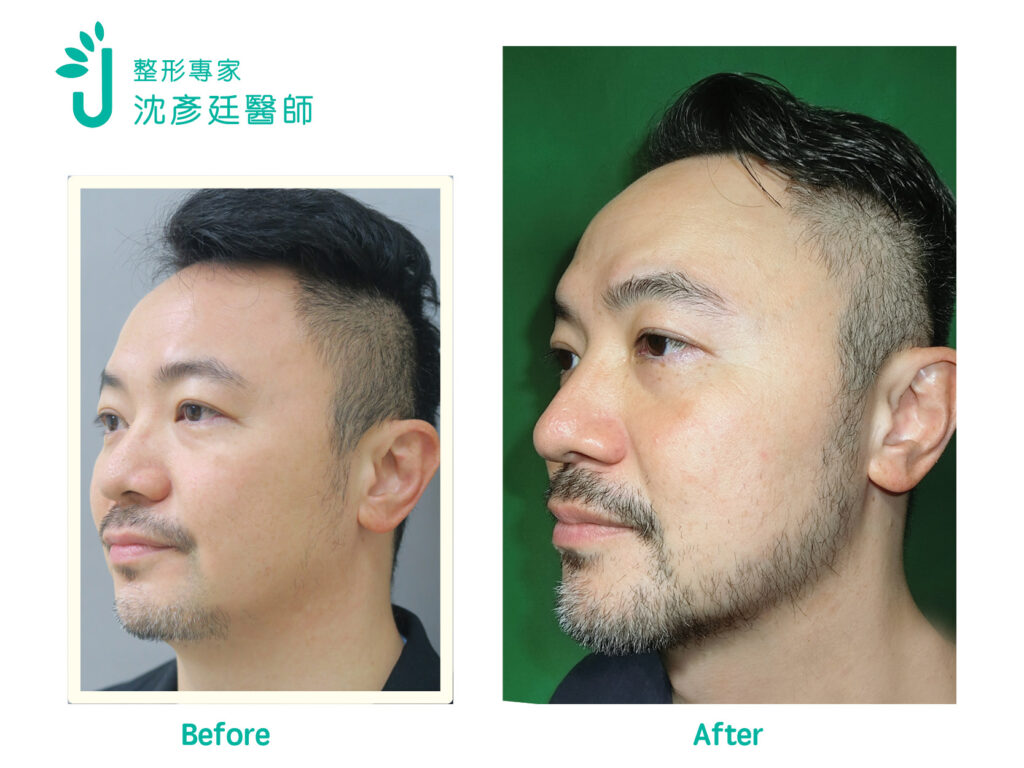鬍鬚與鬢角植髮指南:造型設計、手術流程、恢復期與費用